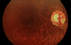 Das Glaukom führt zu Sehkraftverlust durch allmähliche Schädigung des Sehnervs.