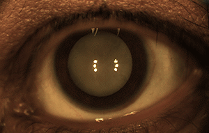 Der graue Star ist eine Linsentrübung im Auge, die zu einem Sehverlust führt.